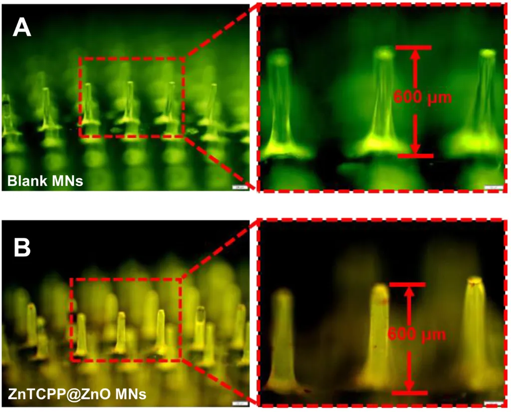 Adesivo de microagulhas, com zoom nos pequenos pinos que são inseridos, de forma indolor, na pele do paciente com acne (Imagem: Xiang et al./Science Advances)