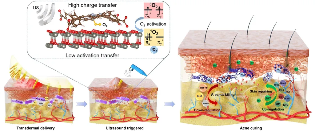 Esquema mostrando o funcionamento do adesivo de microagulhas contra a acne, injetando uma substância que combate a acne mediante a exposição a ondas de ultrassom (Imagem: Xiang et al./Science Advances)