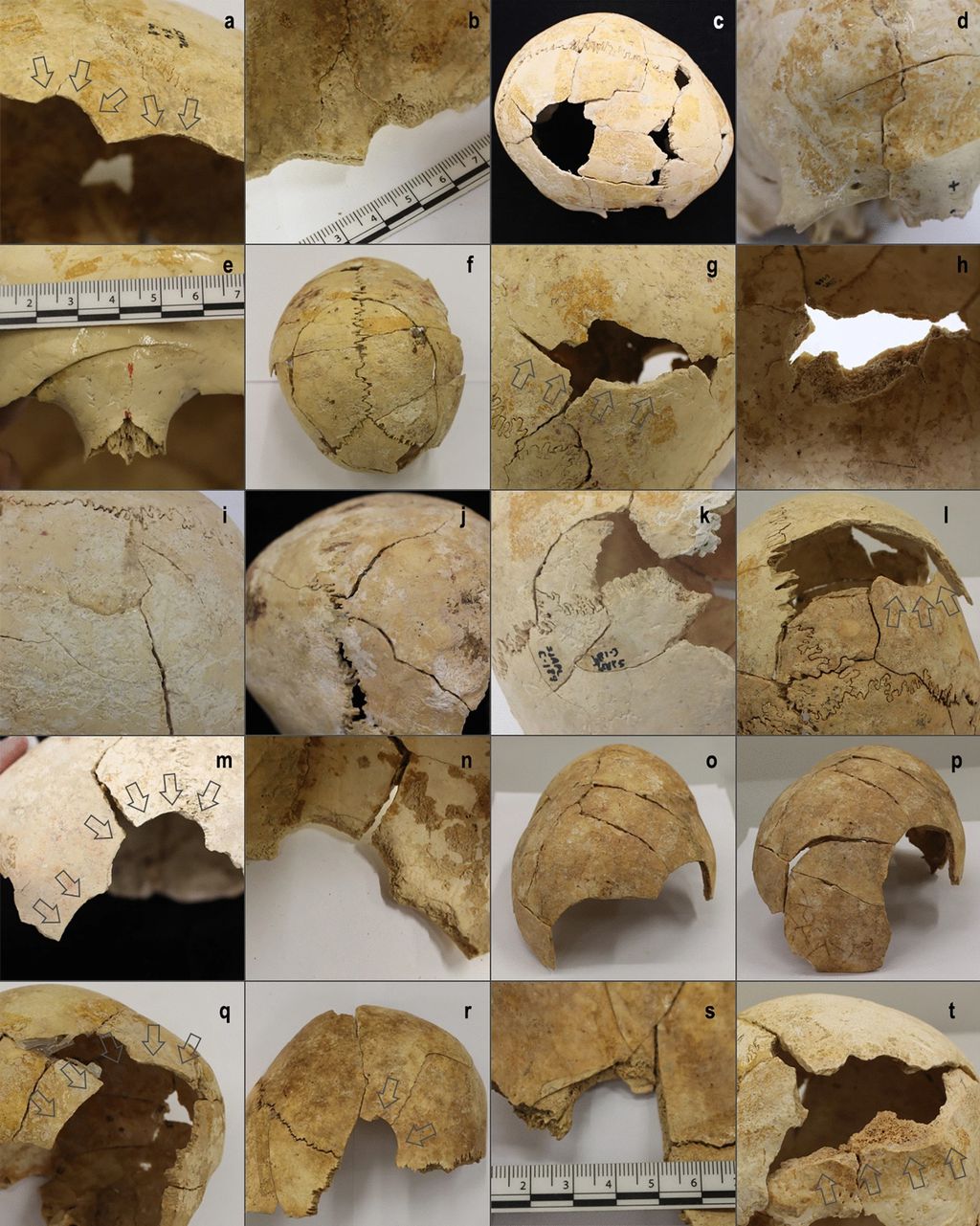 Algumas das feridas cranianas nos restos mortais da Espanha que indicam o conflito milenar do Neolítico Europeu (Imagem: Fernández-Crespo/Scientific Reports)